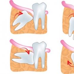 Зубосохраняющие операции: что нужно знать пациенту?